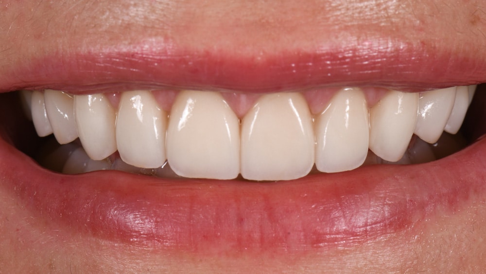 Sorriso depois do tratamento com dez facetas