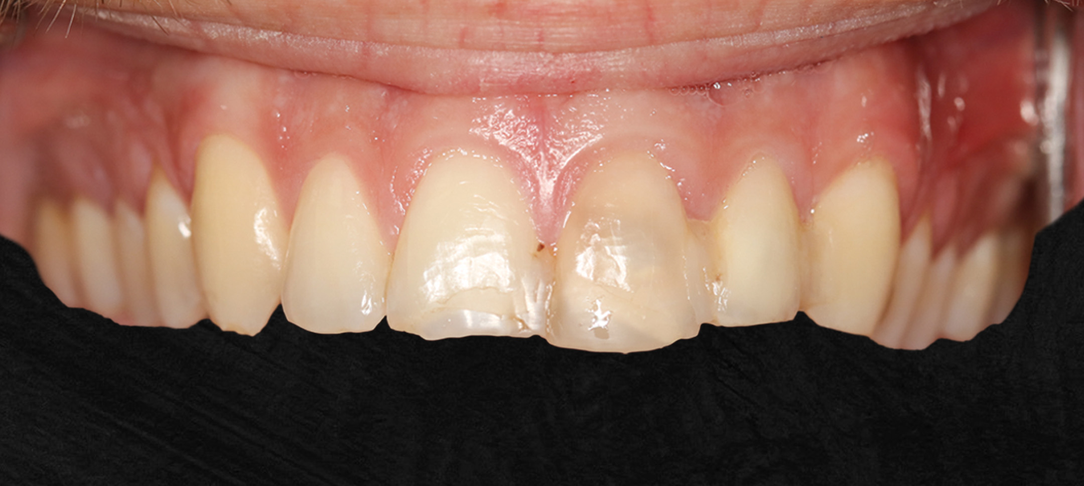 Dentes da frente antes do tratamento após fratura