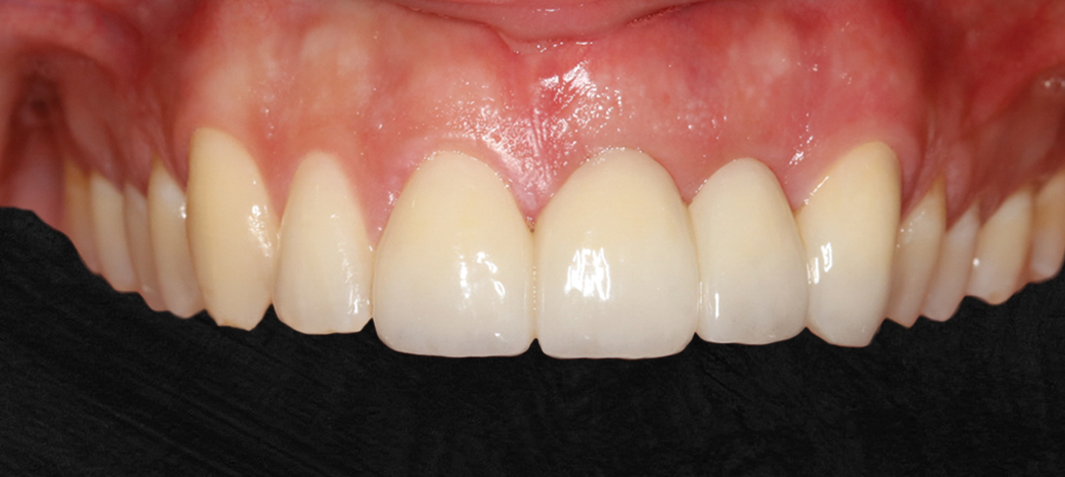 Dentes da frente depois da reabilitação com ponte dentária