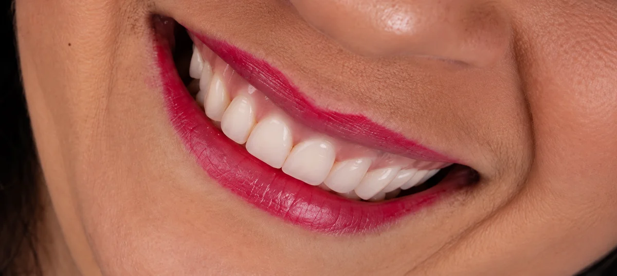 Depois da reconstrução dos dentes anteriores, com sorriso completo